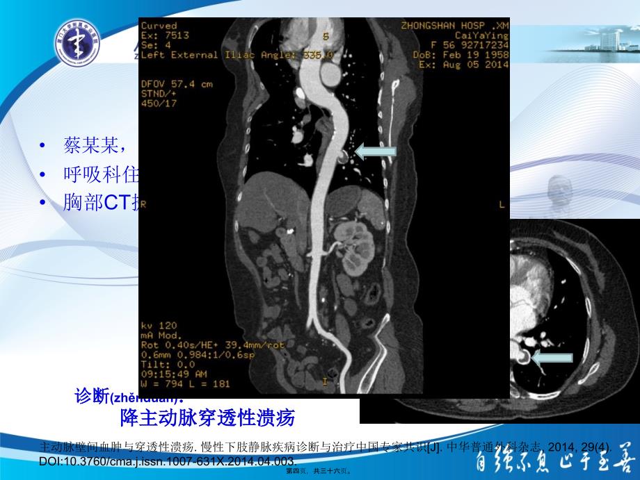 主动脉壁间血肿与穿透性溃疡课件_第4页