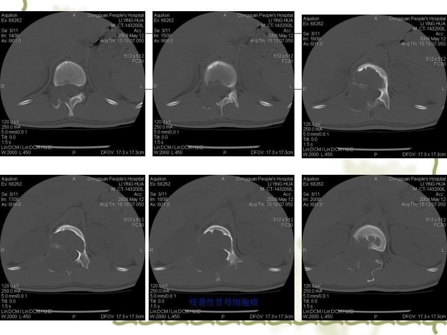侵袭性骨母细胞瘤课件_第5页