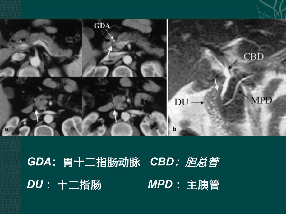 沟槽性胰腺炎.ppt_第4页