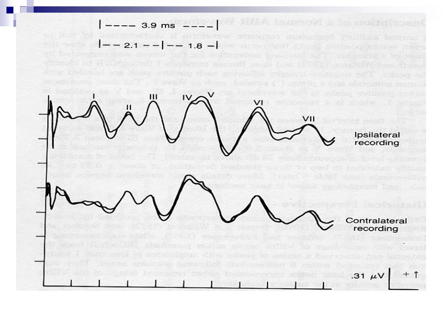 电反应测听(abr).ppt_第3页