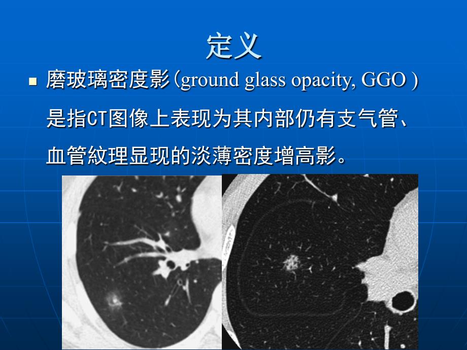 肺磨玻璃密度病变初步探讨讲义课件_第2页