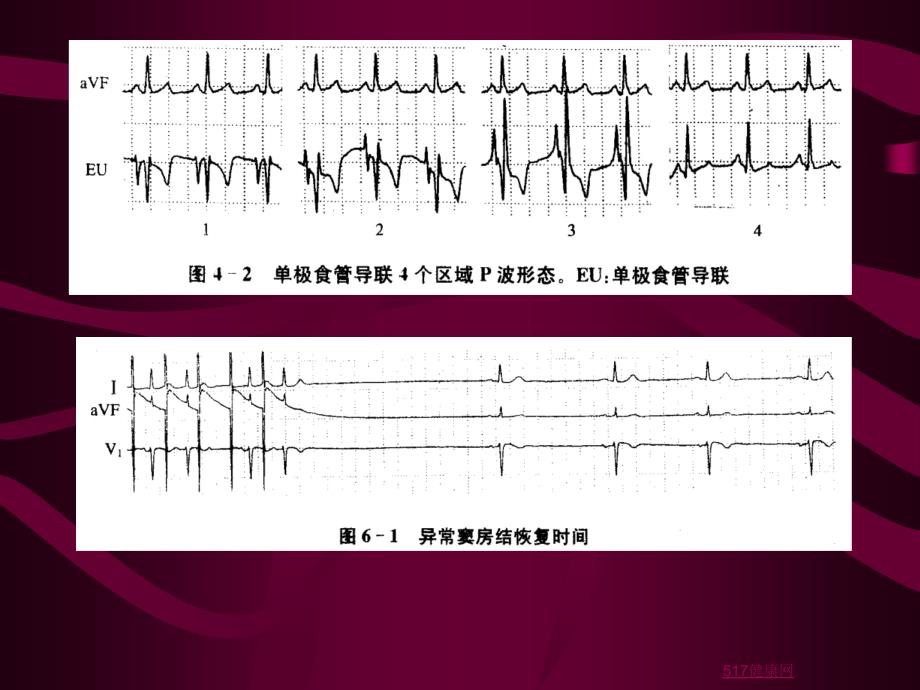 经食道心电生理诊疗运用小常识课件_第4页