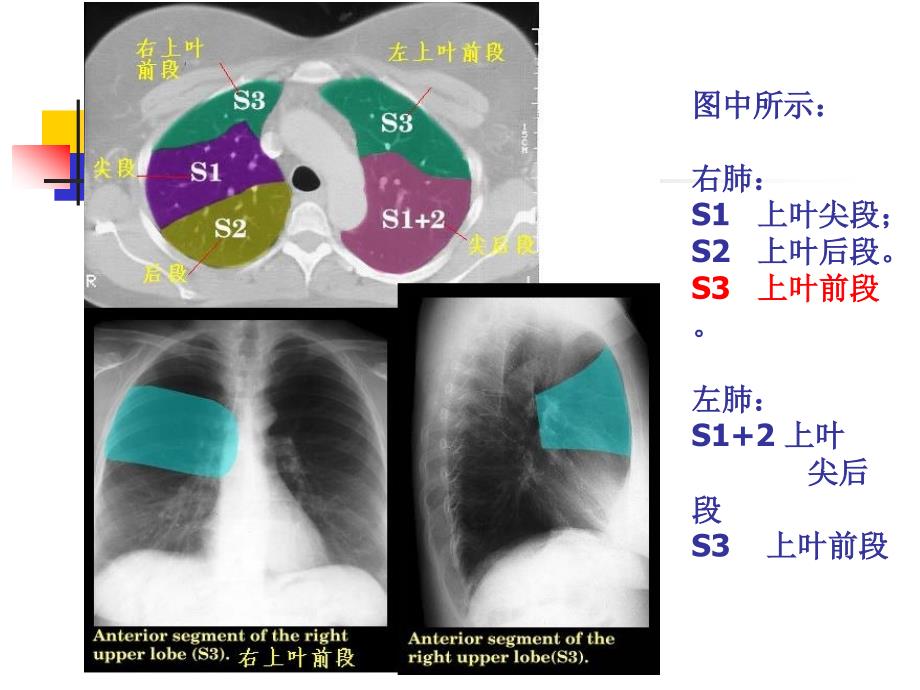 大叶性肺炎的影像诊断精要_第4页