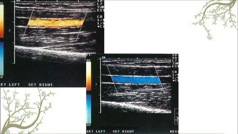 周围血管疾病多普勒超声检查_第5页
