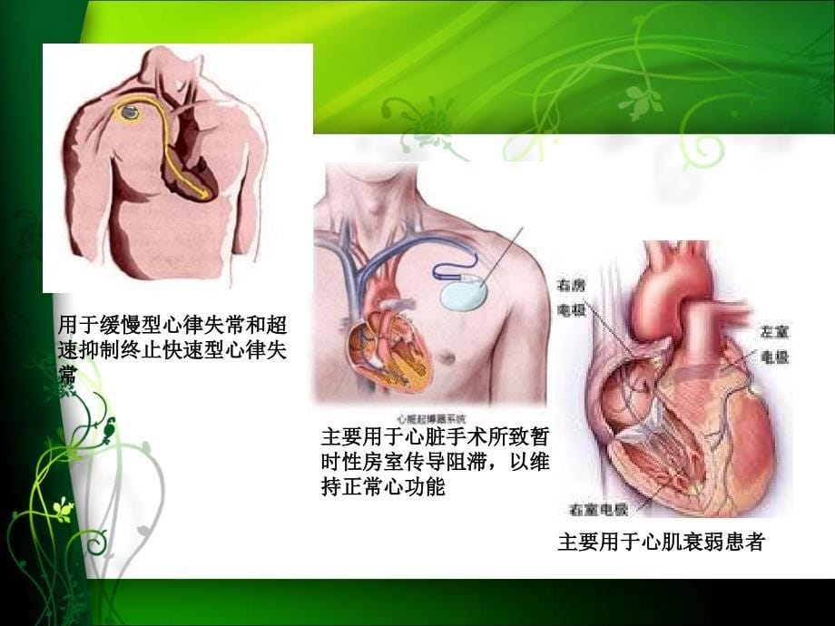 临时起搏的护理2ppt课件_第5页