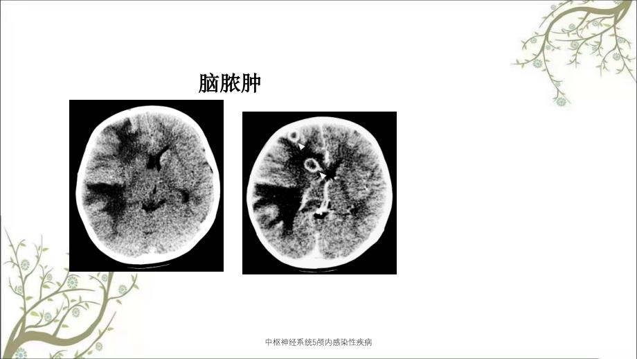 中枢神经系统5颅内感染性疾病_第3页