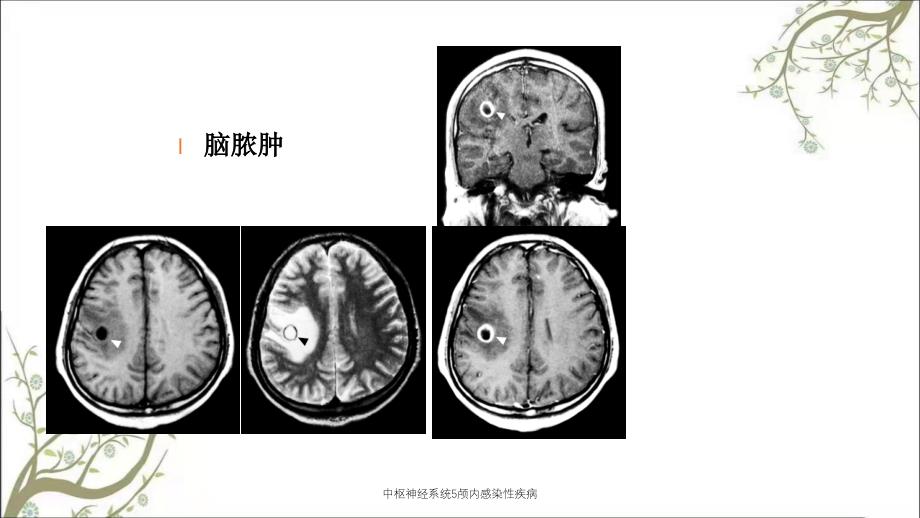 中枢神经系统5颅内感染性疾病_第4页