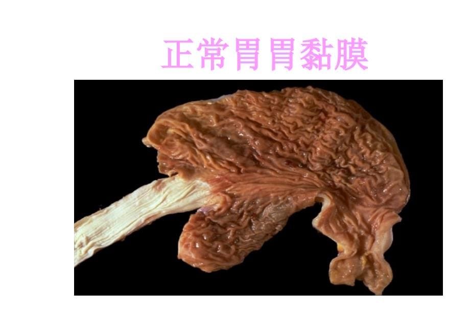 病理学：消化系统 ppt课件_第5页