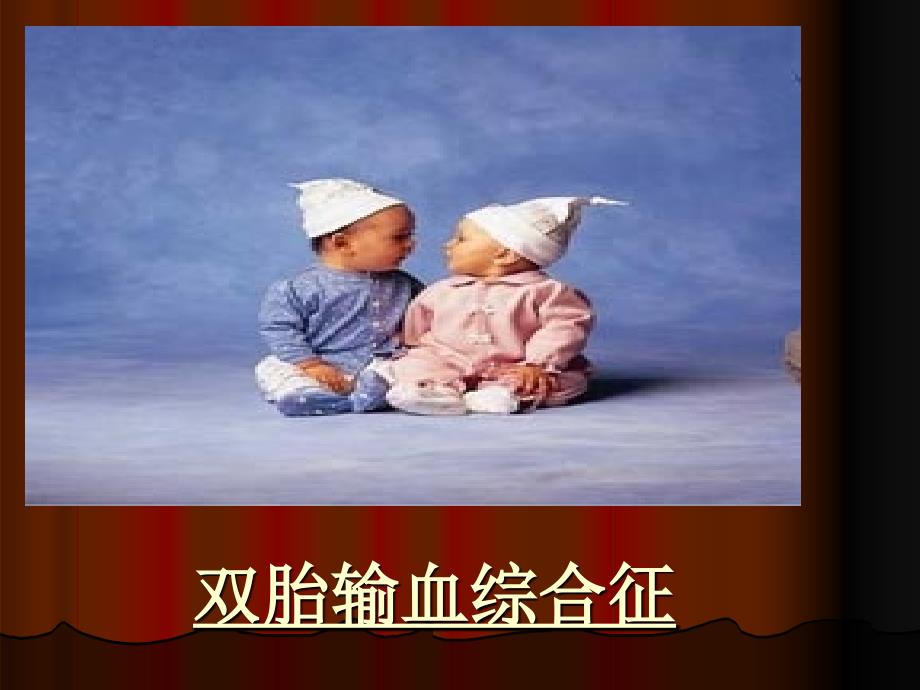 双胎输血综合征课件.ppt_第1页