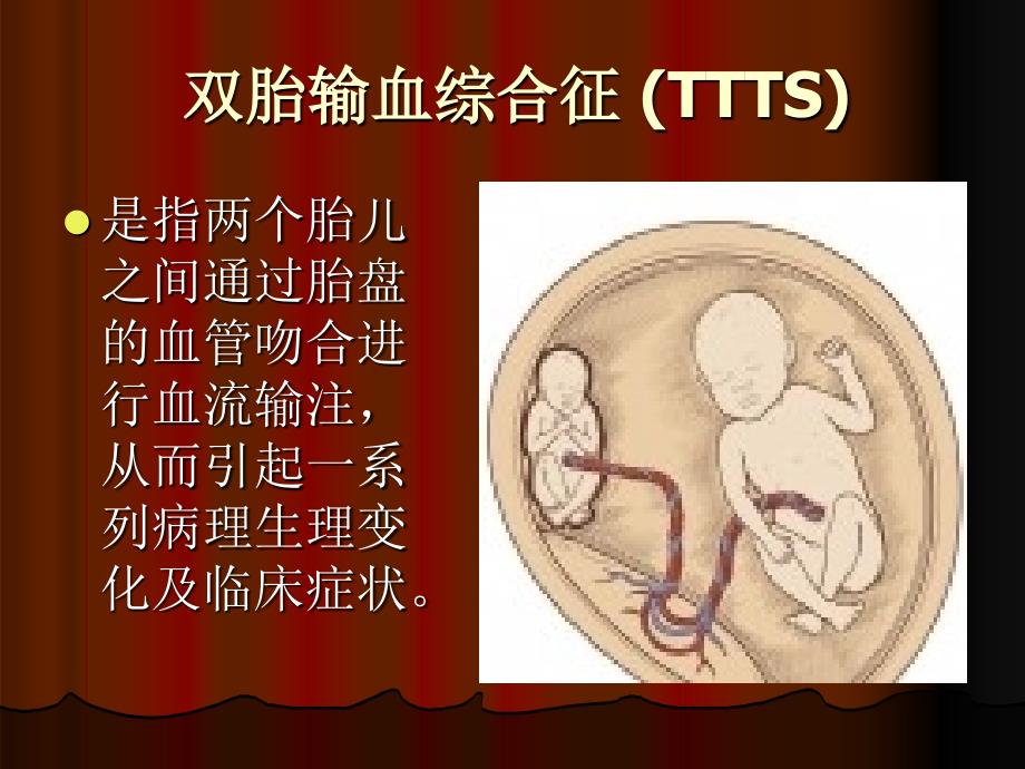 双胎输血综合征课件.ppt_第2页