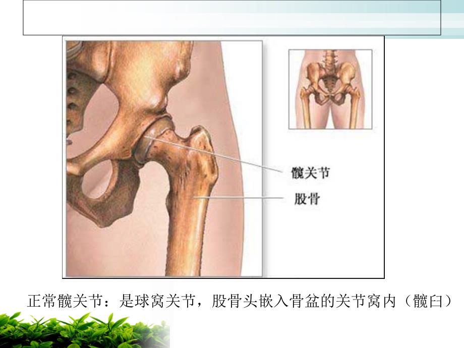 人工髋关节置换术后护理._第3页