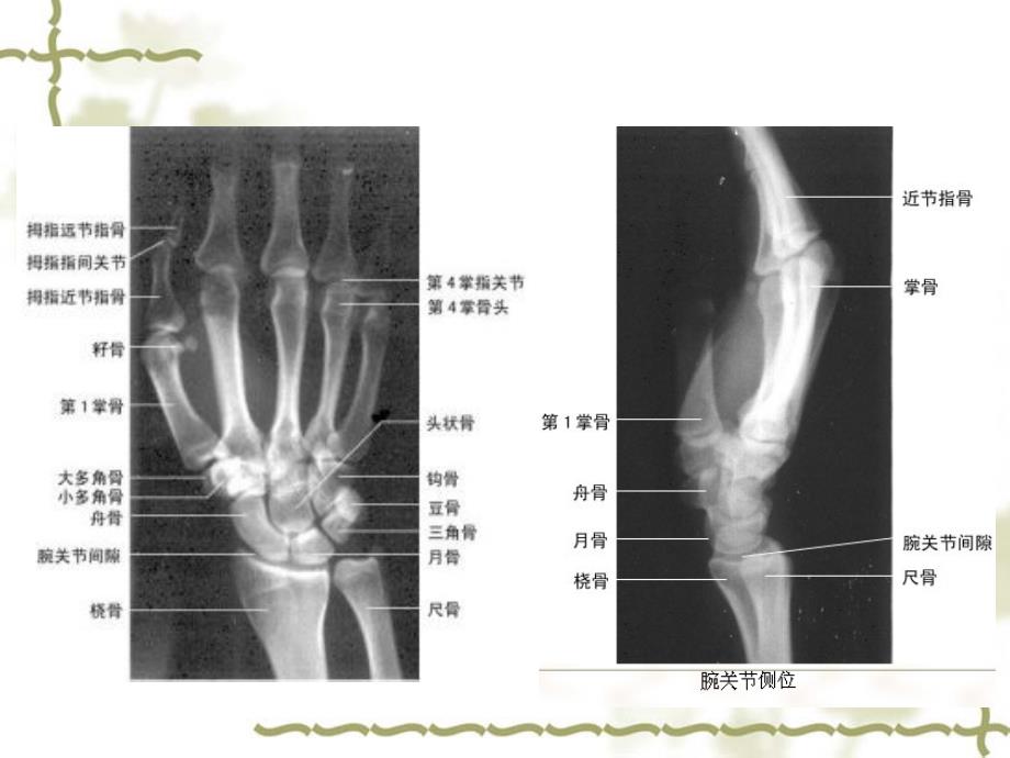 医学影像学：骨关节系统常用检查方法、正常表现、创伤_第4页