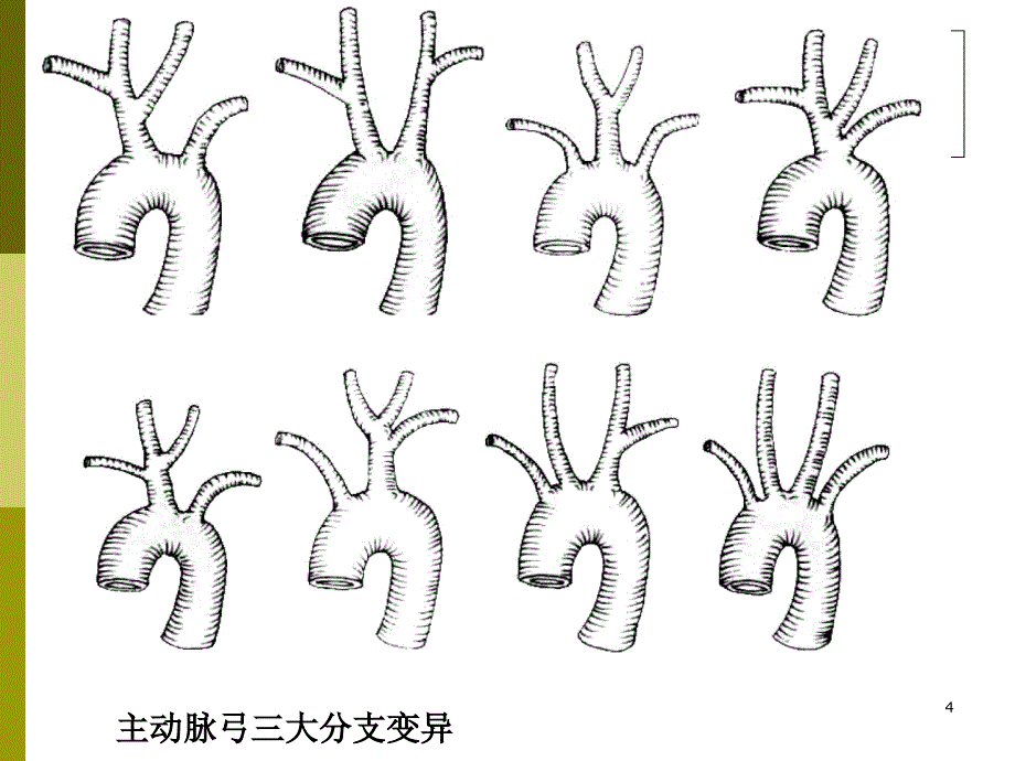 纵隔大血管断层解剖影像_第4页