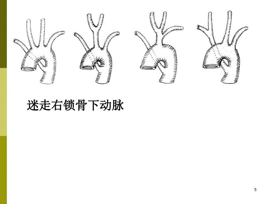 纵隔大血管断层解剖影像_第5页