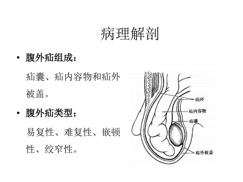 医学院大学课件－－腹 外 疝_第5页