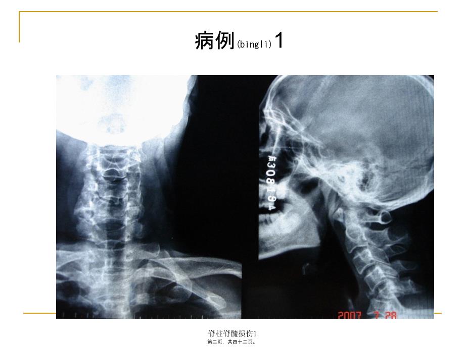 脊柱脊髓损伤1课件_第2页