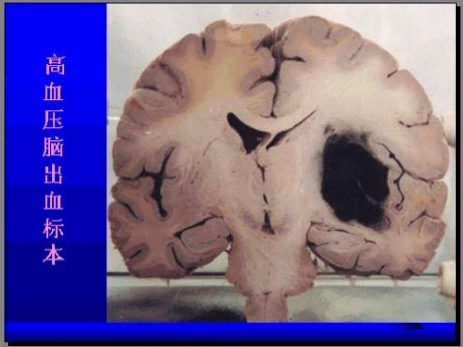 高血压脑出血治疗现状及进展02ppt课件_第3页