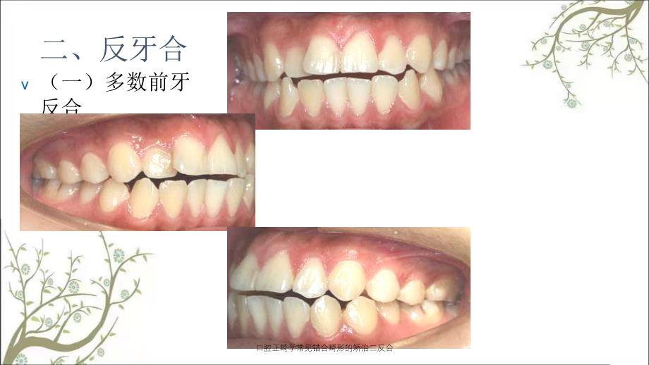 口腔正畸学常见错合畸形的矫治二反合课件_第2页