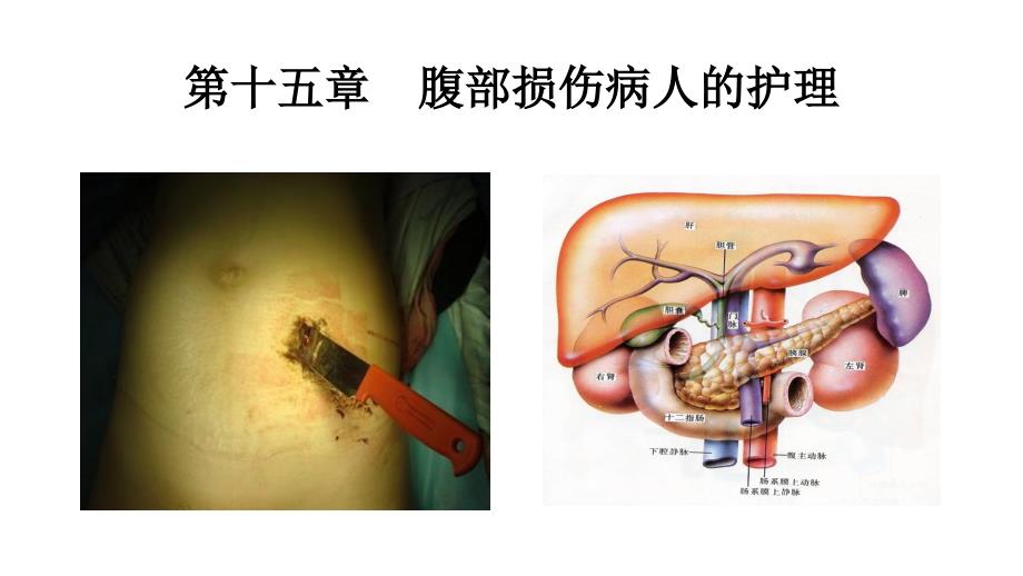 腹部损伤病人的护理.ppt_第1页