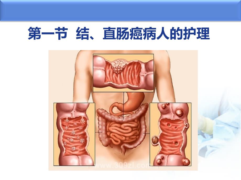 结、直肠和肛管疾病病人的护理ppt_第4页