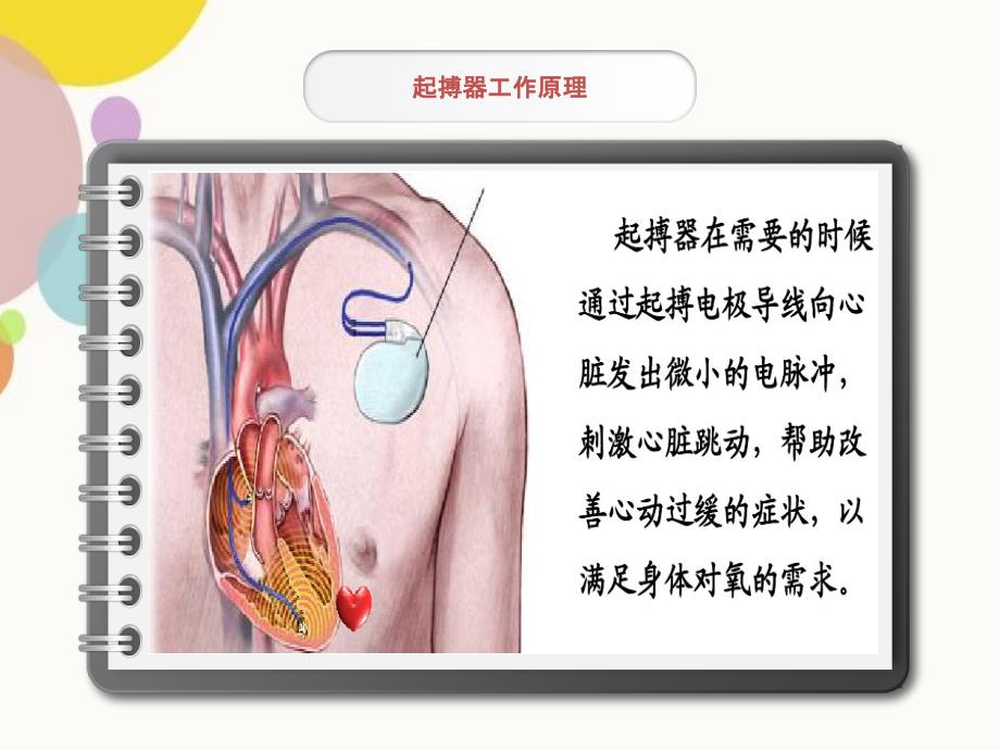 永久性心脏起搏器置入术_第4页