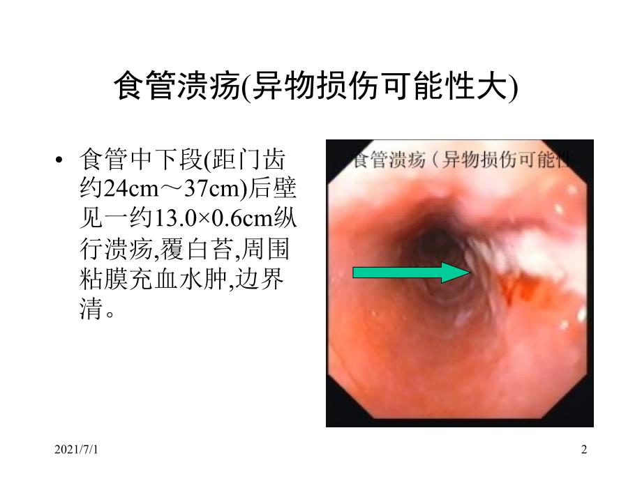 典型内镜图片_第2页