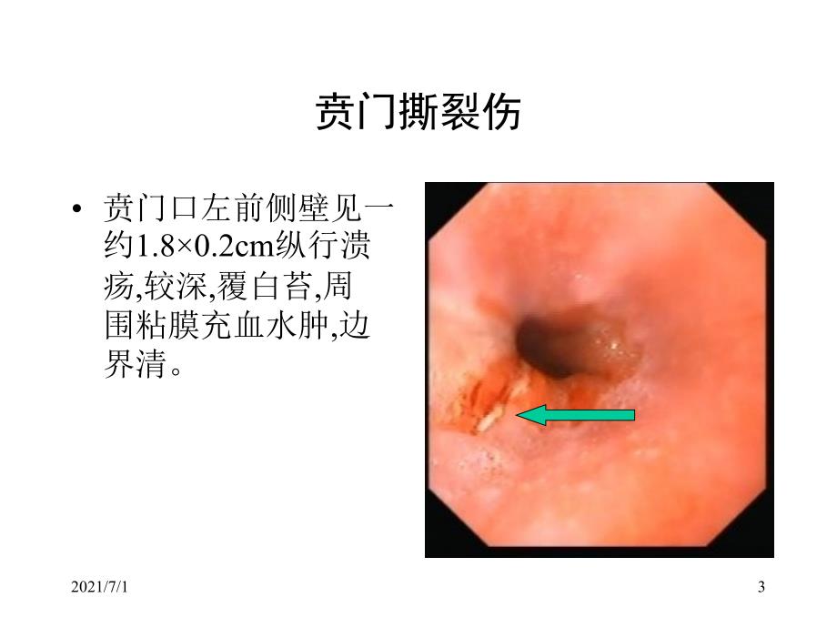 典型内镜图片_第3页