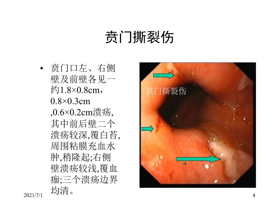 典型内镜图片_第4页