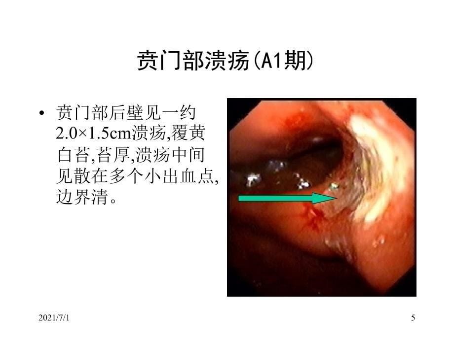 典型内镜图片_第5页