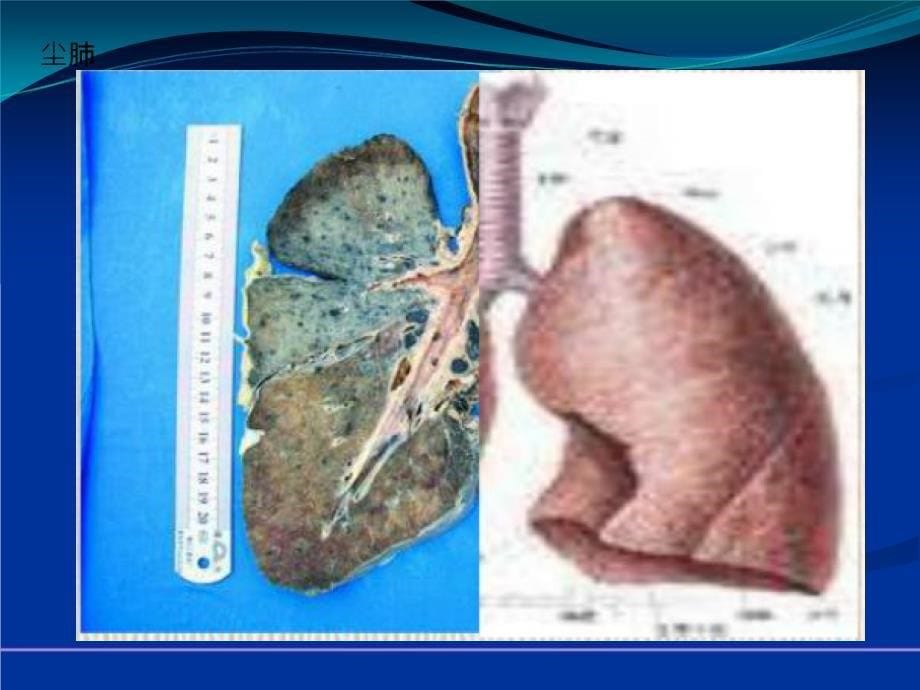 天然气职业病知识培训_第5页