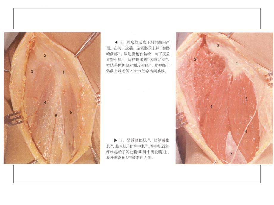 髋关节手术入路ppt课件_第3页