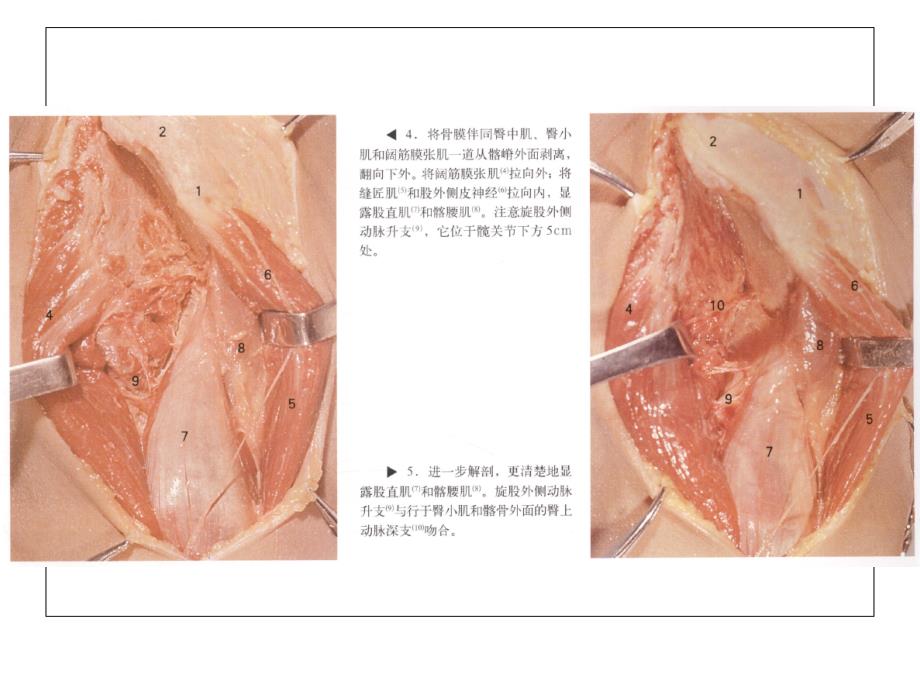 髋关节手术入路ppt课件_第4页