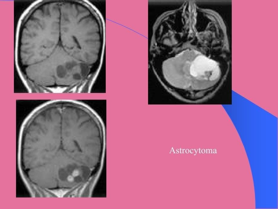 脑肿瘤脊髓肿瘤CTMRIppt课件_第5页