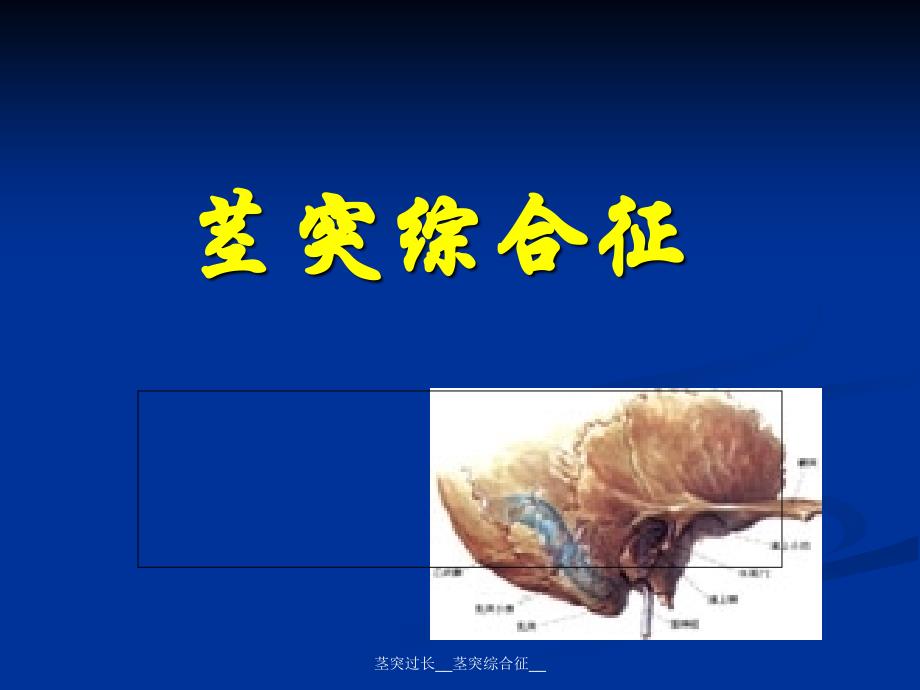 茎突综合征课件_第1页