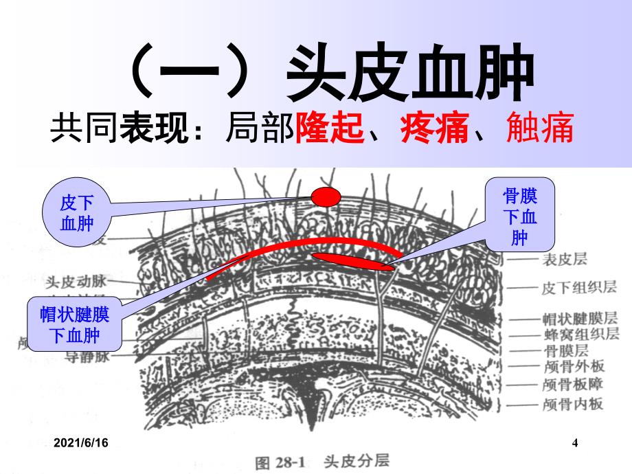 重度颅脑损伤的课件_第4页