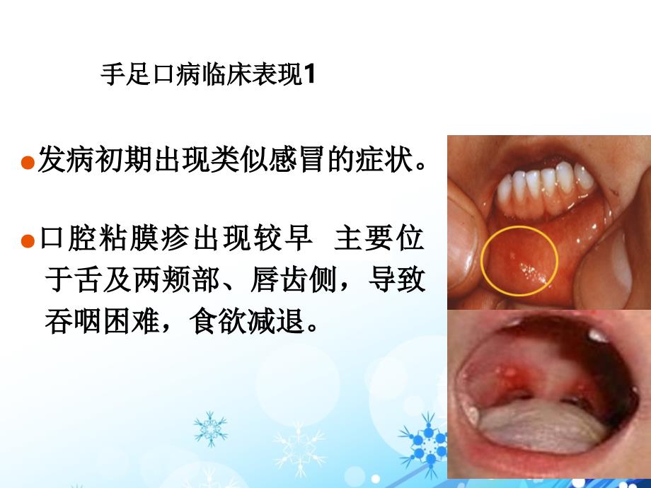 手足口病认识和预防.ppt_第4页