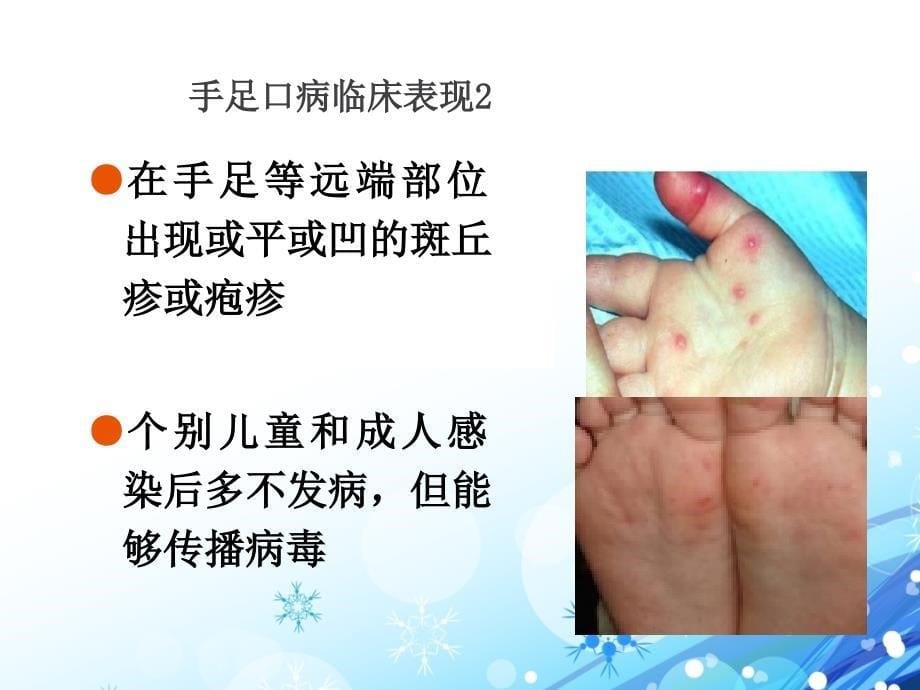 手足口病认识和预防.ppt_第5页