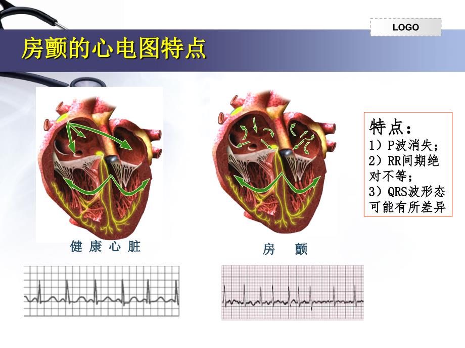 房颤患者的药学监护一例_第4页