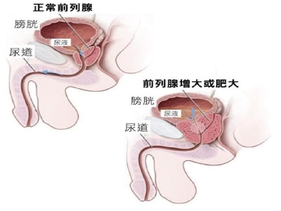 良性前列腺增生症BPH的防治PPT课件_第5页