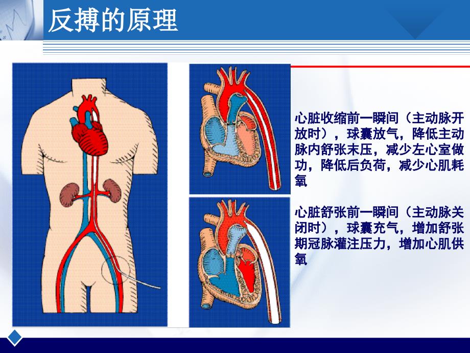 《IABP护理查房》PPT课件.ppt_第4页