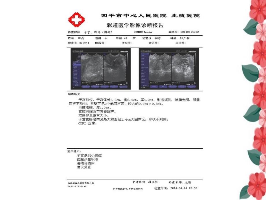 子宫动脉阻断治疗超声对比_第4页