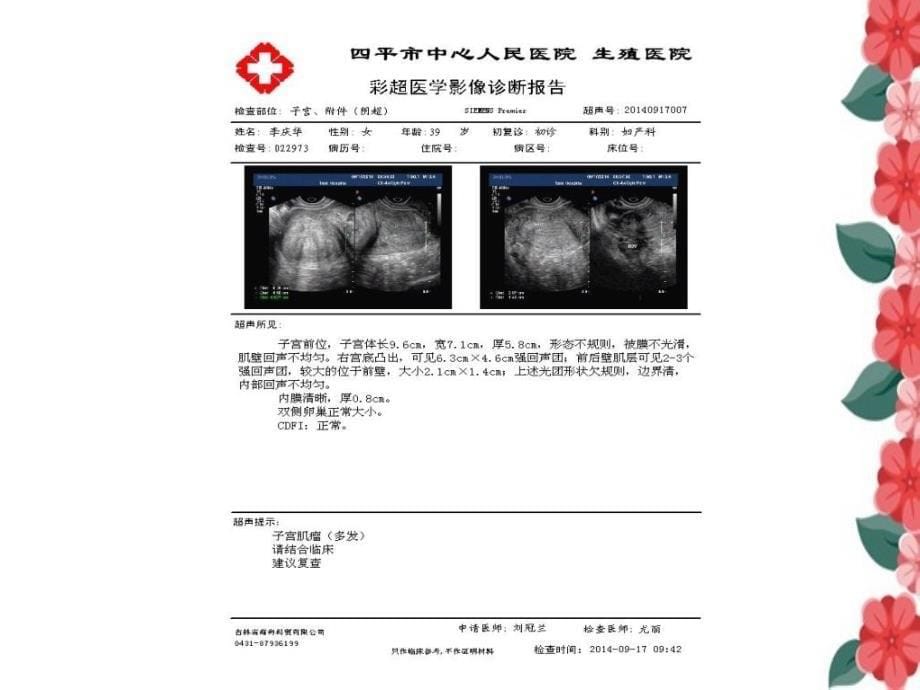 子宫动脉阻断治疗超声对比_第5页