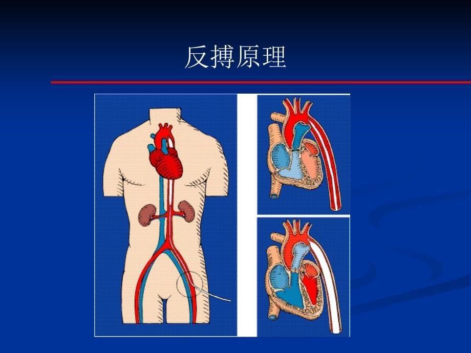 IABP医学原理_第5页