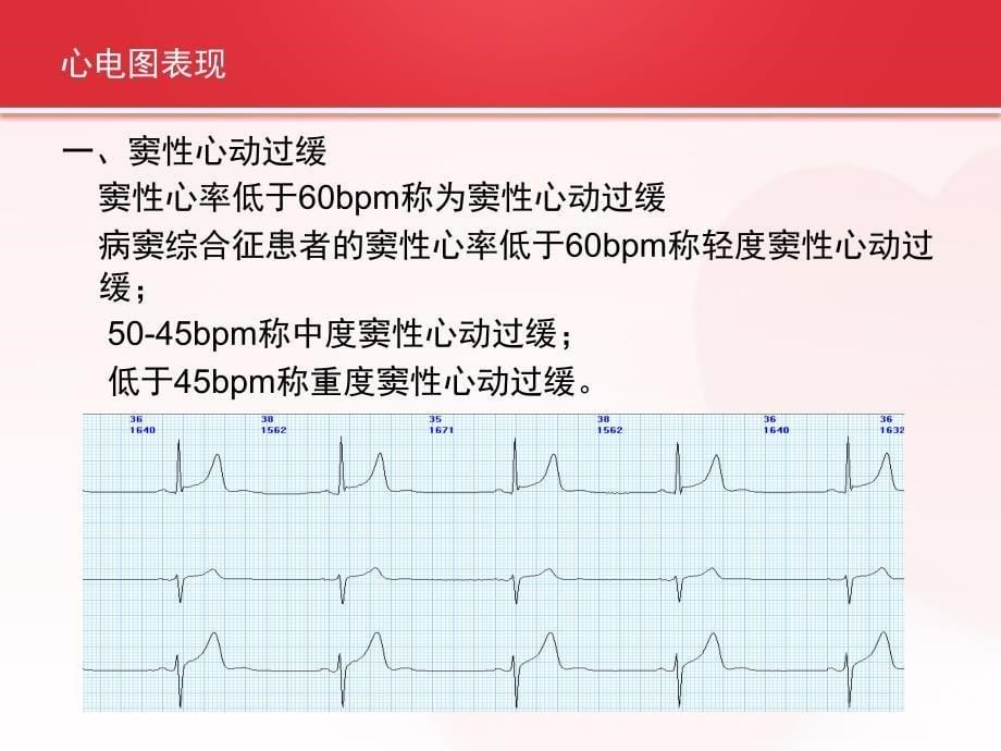 病态窦房结综合症的护理查房ppt演示课件_第5页