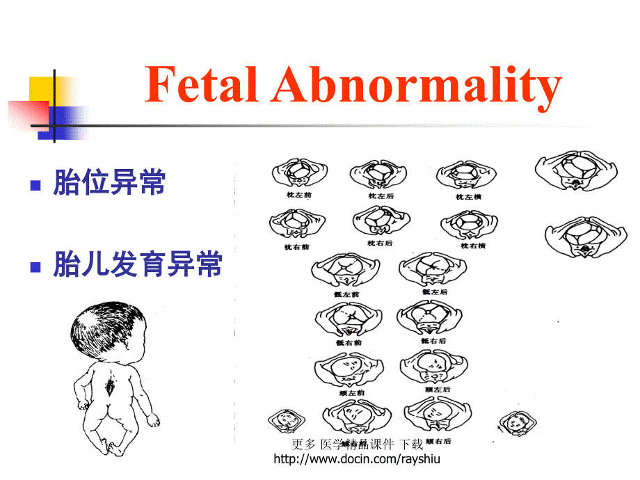 医学ppt课件胎位异常（72p）_第4页