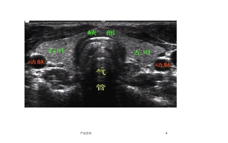 甲状腺的超声解读（行业荟萃）_第4页