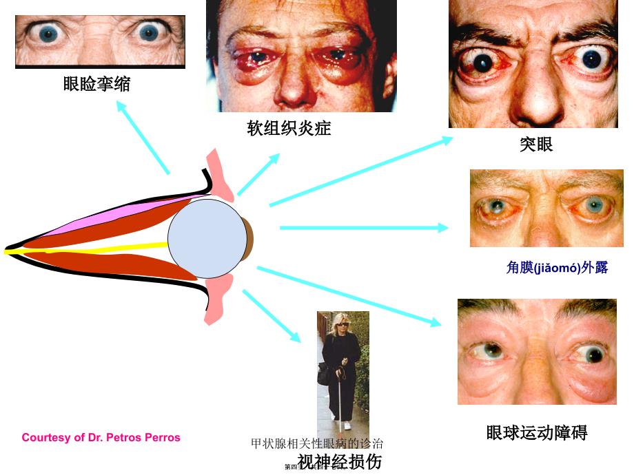 甲状腺相关性眼病的诊治课件_第4页