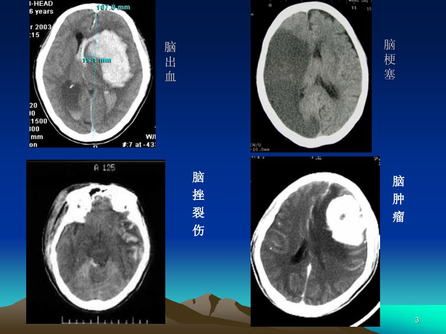 神经外科CT影像基础PPT参考课件_第3页