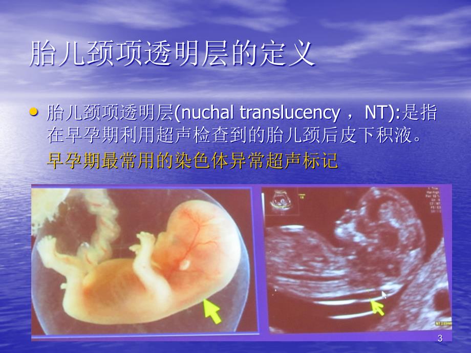 胎儿NT测量标准与临床意义医学PPT课件_第3页