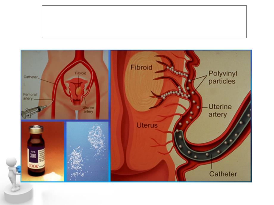 子宫动脉栓塞术与球囊阻断术在产科中的应用_第4页